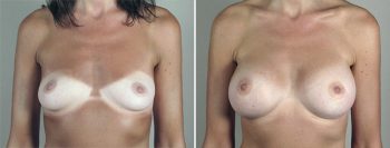 Breast Enlargement (Augmentation) Patient 93