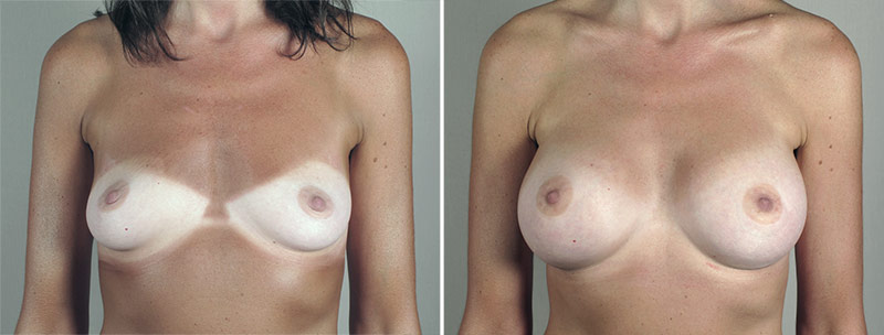 Breast Enlargement (Augmentation) Patient 93