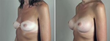 Breast Enlargement (Augmentation) Patient 93