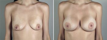 Breast Enlargement (Augmentation) Patient 94