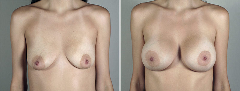 Breast Enlargement (Augmentation) Patient 94