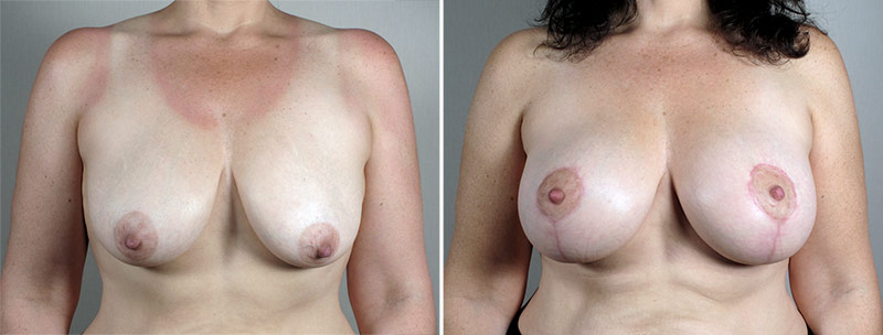 Breast Lift with Implants Patient 40