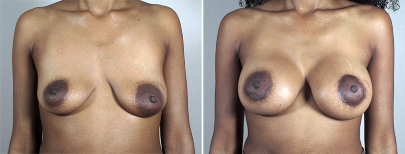 Breast Lift with Implants Patient 41