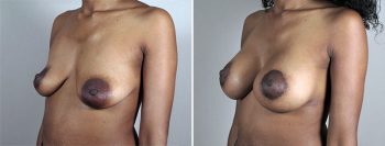 Breast Lift with Implants Patient 41