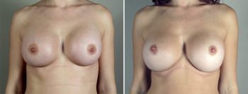 Removal & Replacement of Implants Patient 29