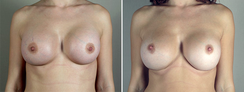 Removal & Replacement of Implants Patient 29