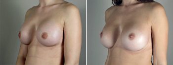 Removal & Replacement of Implants Patient 29