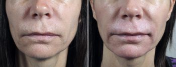 Wrinkle Reduction Patient 7 – Dermabrasion