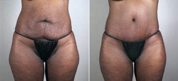 Parker Tummy Tuck Patient 48