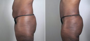 Parker Tummy Tuck Patient 48