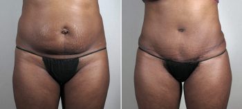 Parker Tummy Tuck Patient 49