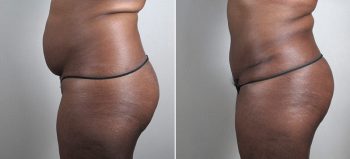 Parker Tummy Tuck Patient 49