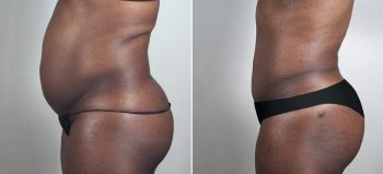 Parker Tummy Tuck Patient 50