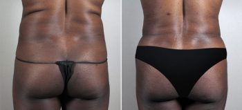 Parker Tummy Tuck Patient 50