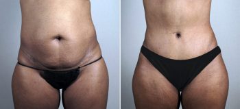 Parker Tummy Tuck Patient 51
