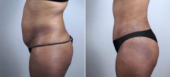 Parker Tummy Tuck Patient 51