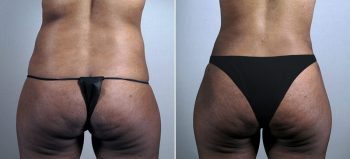 Parker Tummy Tuck Patient 51