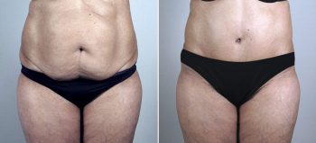 Parker Tummy Tuck Patient 52