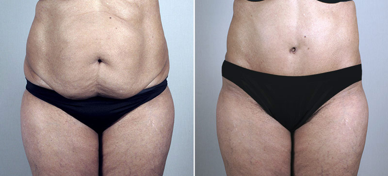 Parker Tummy Tuck Patient 52