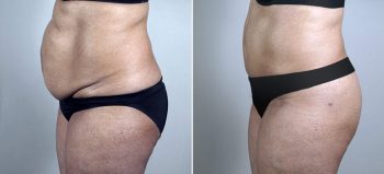 Parker Tummy Tuck Patient 52