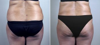 Parker Tummy Tuck Patient 52