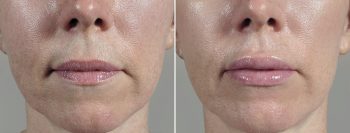 Lip Enhancement Patient 12