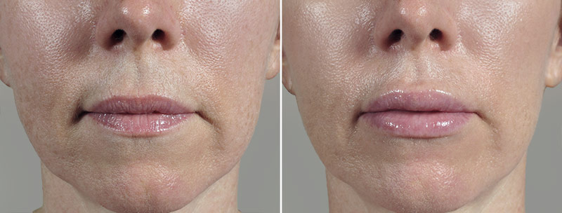 Lip Enhancement Patient 12