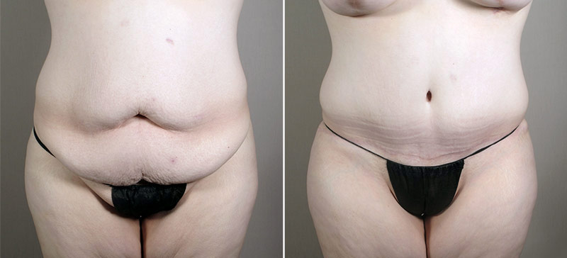 Parker Tummy Tuck Patient 47