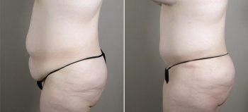 Parker Tummy Tuck Patient 47