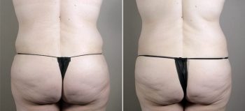 Parker Tummy Tuck Patient 47