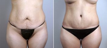 Mommy Makeover Patient 28