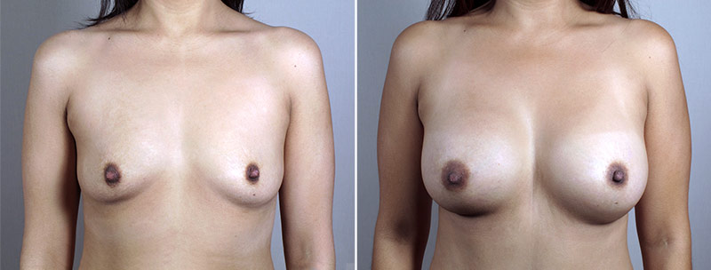 Mommy Makeover Patient 28