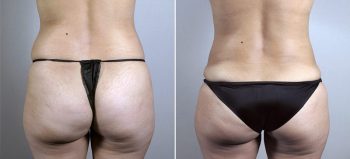 Mommy Makeover Patient 28