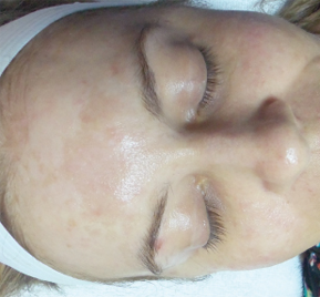 after rezenerate for sun damage