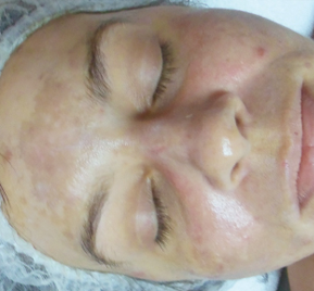 Rezenerate new jersey before sun damage treatment