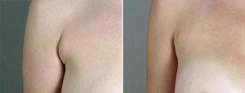 Breast Enlargement (Augmentation) Patient 95