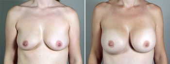 Breast Enlargement (Augmentation) Patient 95