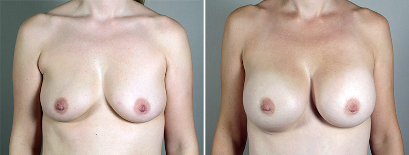 Breast Enlargement (Augmentation) Patient 95