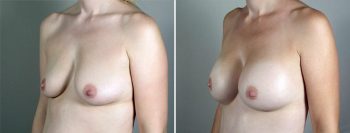 Breast Enlargement (Augmentation) Patient 95