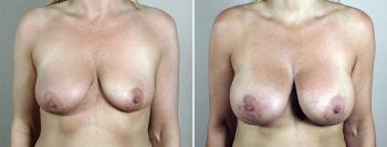 Breast Lift with Implants Patient 42