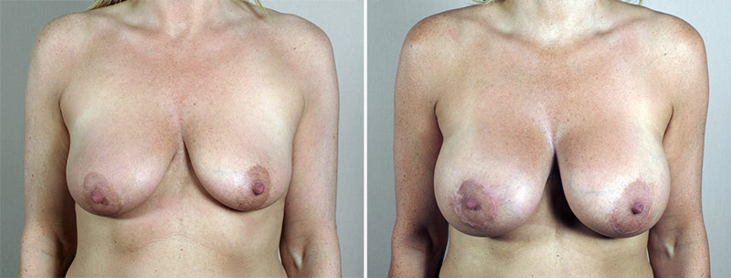 Breast Lift with Implants Patient 42