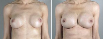 Removal & Replacement of Implants Patient 31