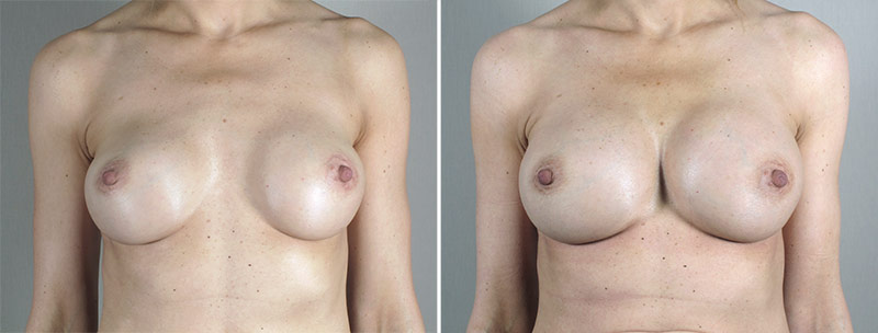 Removal & Replacement of Implants Patient 31