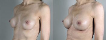 Removal & Replacement of Implants Patient 31