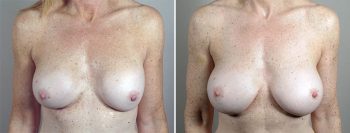 Removal & Replacement of Implants Patient 32