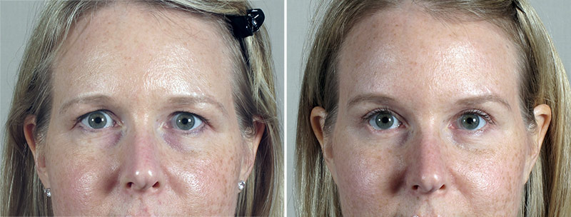Browlift & Eyelid lift Patient 56