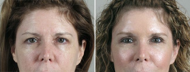Before & After Upper Eyelid Lift 