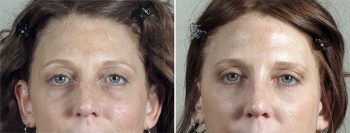 Lower Eyelid Lift Patient 15