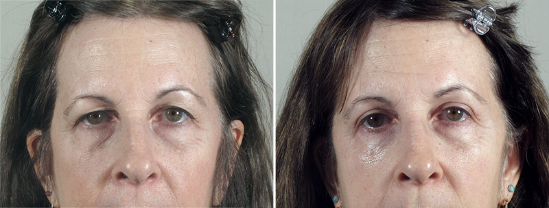 Browlift & Lower Eyelid Lift Patient 16