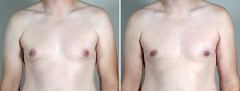 Gynecomastia Reduction Patient 54-2